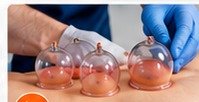 Cupping therapy treatment